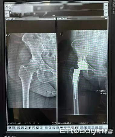 ▲▼   告別舉步維艱！嘉榮「正前開」人工髖關節置換術 讓患者術後當天即可下床走路   。（圖／嘉榮灣橋分院提供）