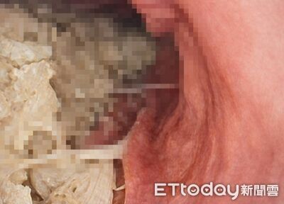 空腹12小時「還滿肚食物渣」！她打瘦瘦針下場　醫嘆：胃癱瘓了