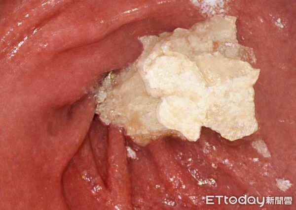 ▲▼空腹12小時「胃中離奇畫面」曝！她打瘦瘦針下場&hellip;醫嘆：胃癱瘓了。（圖／許秉毅醫師授權提供，未經同意請勿任意翻攝）