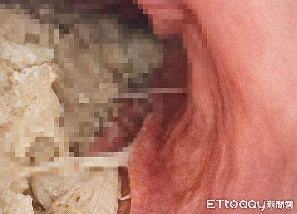 ▲▼空腹12小時「胃中離奇畫面」曝！她打瘦瘦針下場&hellip;醫嘆：胃癱瘓了。（圖／許秉毅醫師授權提供，未經同意請勿任意翻攝）