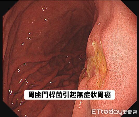 ▲▼不菸酒罹胃癌&hellip;他嚇壞：只是脹氣！醫揭元凶「30%台人都有」。（圖／林相宏醫師授權提供，未經同意請勿任意翻攝）