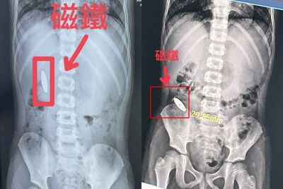 小五童逼小一學弟「吞3cm磁鐵」！卡腸子還沒出來　補習班3違規開罰
