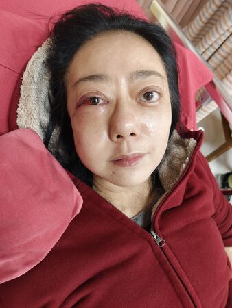 ▲高慧君昏倒，臉部3處地方骨折。（圖／經紀人提供）