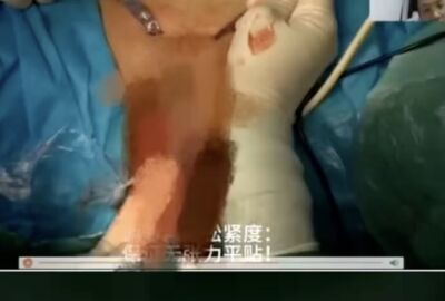 陸醫院線上直播「女性私密處」全都露　5萬多人觀看緊急喊卡