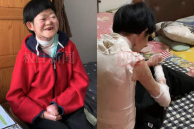 曾被斷言活不過2歲！陸「蝴蝶寶貝」將滿25歲…歷經5次分指手術