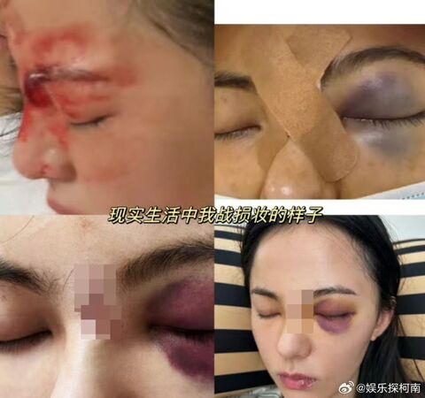 ▲▼陸劇女神受傷「臉縫7針」遭換角！黃日瑩傳改拍短劇。（圖／翻攝自微博）