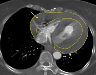 她頭暈摔車竟「心包積血＋主動脈剝離」　死亡率極高當心5症狀