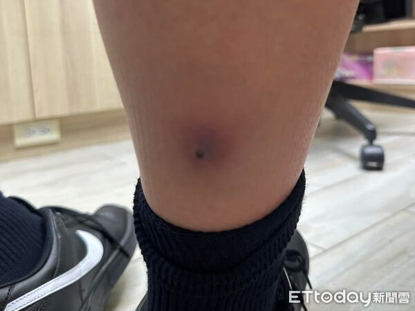 ▲以為流感！12歲弟發燒「一拉起褲管」&hellip;醫驚喊：快衝急診。（圖／旭恩小兒科診所授權提供）