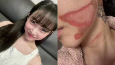 女星打音波出事！睡起來毀容：皮膚層層撕開捲起⋯　流膿傷照曝光