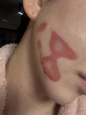 ▲▼前AOA珉娥打音波出事！睡起來毀容：皮膚層層被撕開　流膿傷照曝光。（圖／翻攝自珉娥IG）