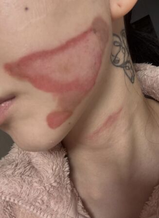 ▲▼前AOA珉娥睡起來毀容：皮膚層層被撕開　流膿傷照曝光。（圖／翻攝自珉娥IG）