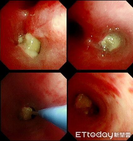 ▲▼嬤餵一口花生&hellip;1歲孫咳嗽「肺已開始塌陷」！醫怒：到底要講幾次。（圖／廖穗綾醫師授權提供，未經同意請勿任意翻攝）