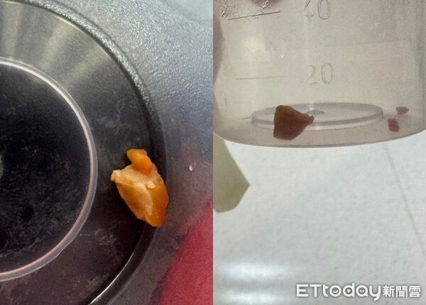 ▲▼嬤餵一口花生&hellip;1歲孫咳嗽「肺已開始塌陷」！醫怒：到底要講幾次。（圖／廖穗綾醫師授權提供，未經同意請勿任意翻攝）