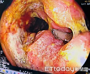 以為只是痔瘡…男「過年前罹癌」1句話逼哭醫！3大症狀別再拖