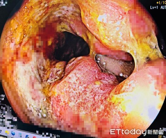 以為只是痔瘡…男「過年前罹癌」1句話逼哭醫！3大症狀別再拖