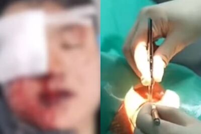 陸男放鞭炮釀右眼破裂…恐將摘除眼球　他哭喊：怎面對5月大女兒