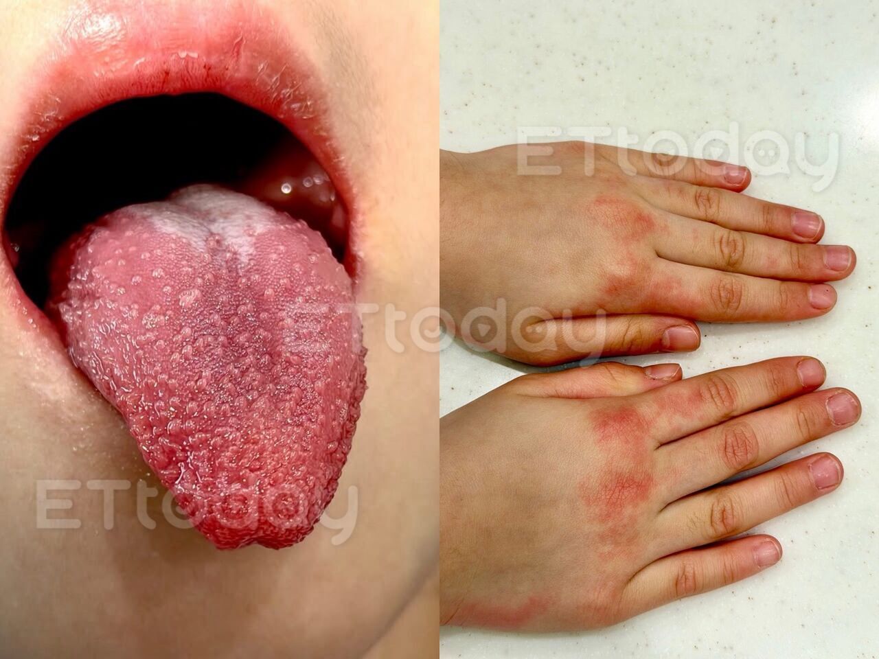 獨/4歲童高燒4天驚見「草莓舌」 醫響警報:恐釀終身心臟後遺症