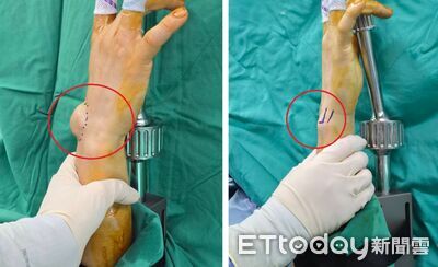 恐怖「筋瘤」纏身！科技男手腕隆起像乒乓球　醫曝4職業高風險群