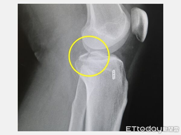 ▲電腦斷層影像顯示骨塊被韌帶拉起位置，屬典型外傷型態。（圖／記者游瓊華翻攝）