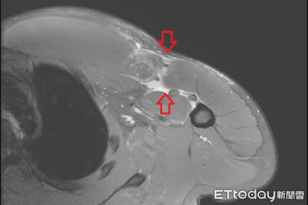 一名男性臥推，胸大肌斷裂。（圖／院方提供）