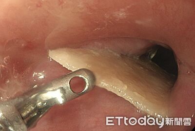 他喉嚨痛…醫夾出「2.5cm菱形骨」！ 誤吞5類異物恐穿孔