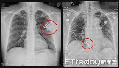 心跳每分鐘僅12下確診「病竇症候群」　婦植入新型節律器防猝死