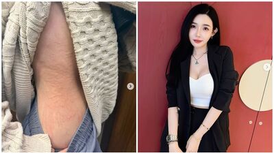 許允樂掀衣「側腰大面積發腫」！突發蕁麻疹1個月⋯過敏原出爐崩潰了