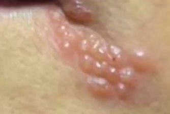 30歲女「嘴角起水泡」未理會竟致「腦死」　醫嘆：無法根治