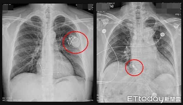 ▲▼   節律器          。（圖／雙和醫院提供）
