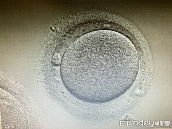 ▲今年剛滿30歲的輕熟女小方，因家族媽媽跟阿姨們都有乳癌的病史，洗澡的時候摸到乳房有一個腫塊，結果確診乳癌第二期，得接受化學治療。由於小方未婚，擔心化療影響生育，決定凍卵，最終取得20幾顆成熟卵子，讓小方可以安心快速的銜接乳癌化學治療。（圖／大里仁愛提供）