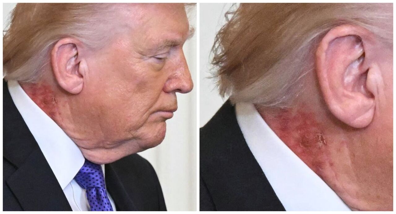 79歲川普「脖子紅一片」還脫屑!健康再掀疑雲 白宮御醫曝真相