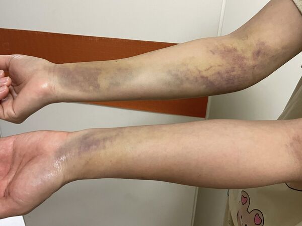 ▲▼美女主播黃慧婷驚傳肺部開刀！　親睹「長針穿入胸口」落淚。（圖／翻攝自臉書）