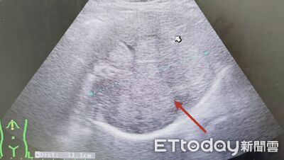 以為切完就沒事！他7年沒回診　醫一照驚見「無數腫瘤佔滿肝臟」