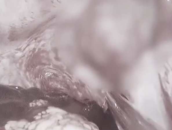 ▲▼陸情侶同房後女友黃體破裂險喪命。（圖／翻攝自微博）