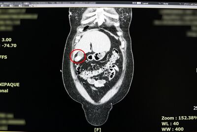 胃痛反覆發作竟然是「飽痛」？　醫師：她確診為急性膽囊炎