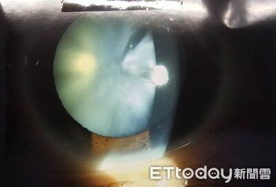 視力剩0.1！32歲男「眼球慘變雪花白」　醫見血糖飆400：被侵蝕了