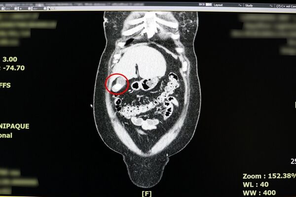 ▲胃炎膽囊炎分不清？
