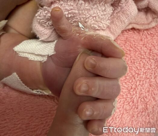 ▲▼13週大出血「她躺到生」拚命保胎！孩子多1根手指&hellip;母告白醫淚崩。（圖／周靜汶醫師授權提供，未經同意請勿任意翻攝）