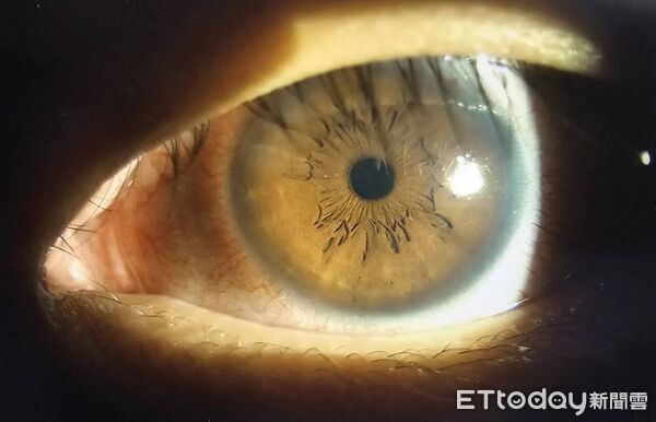 ▲▼視力剩0.1！32歲男「眼球慘變雪花白」　醫見血糖飆400：被侵蝕了。(圖／徐浩恩醫師授權提供)