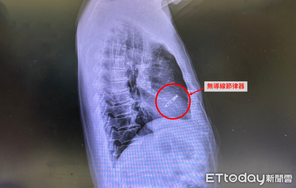 ▲▼   節律器         。（圖／中醫大新竹附醫提供）