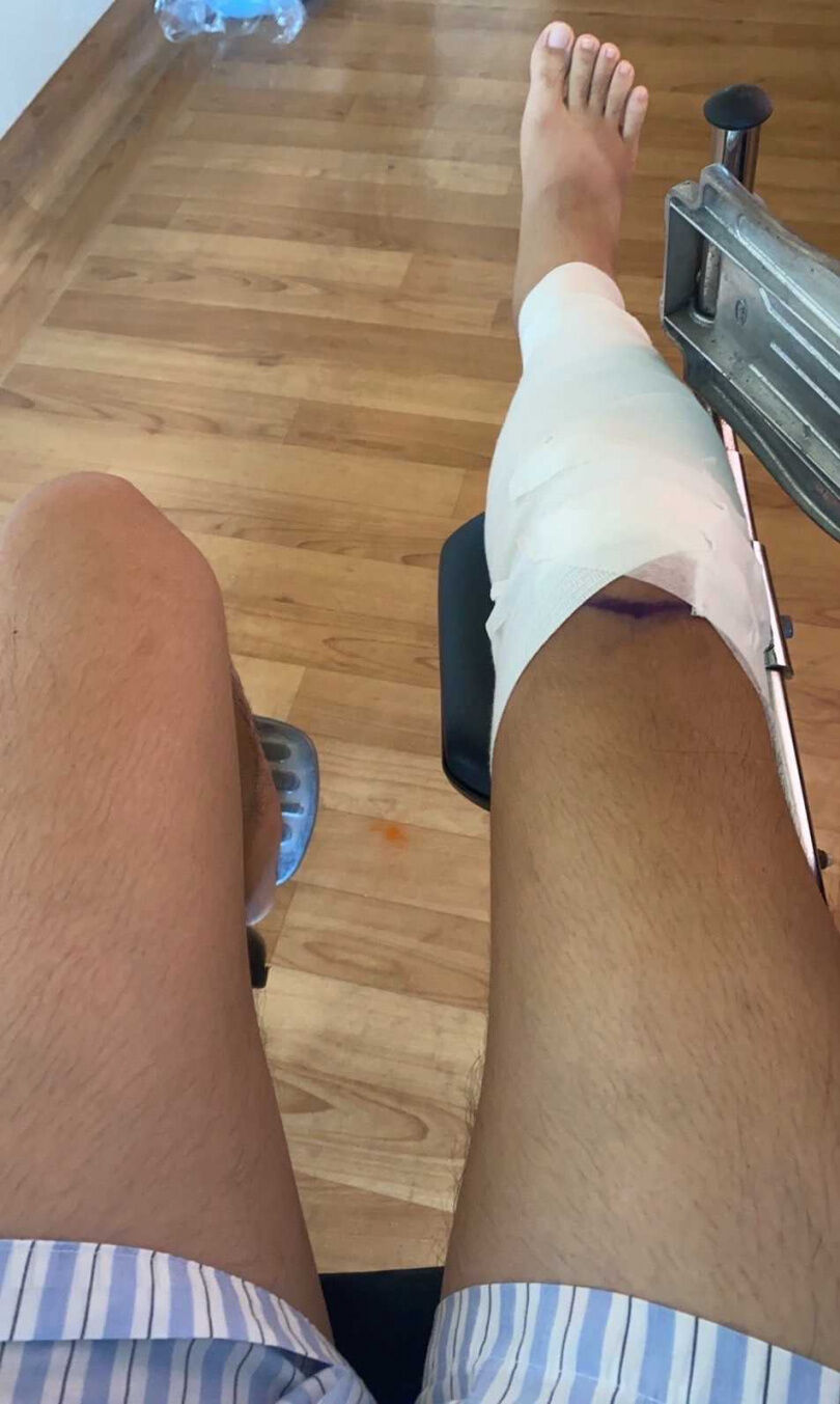 S姓男子發生車禍後右小腿骨折，還需打入骨釘，而羅姓印尼籍學生僅受有全身多處擦挫傷。（圖／民眾提供）