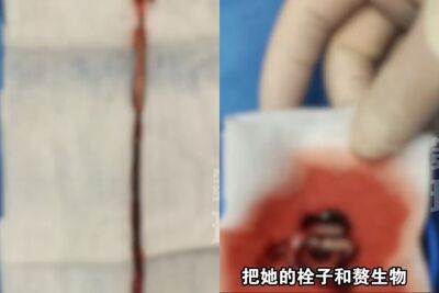 陸女高燒9天竟因「輸液管被血栓堵死」　醫嚇：感染炸彈險喪命