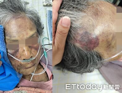 惡孫討不到錢痛毆90歲嬤！全身黑青畫面曝　腦出血送加護病房