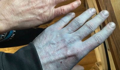 男睡醒皮膚突然變藍「慘變阿凡達」　急診醫護嚇壞棉片一擦笑噴