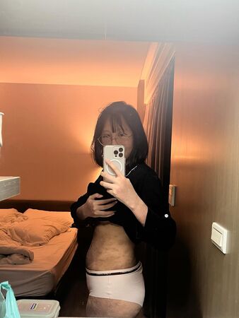 ▲▼織織產後9個月「全身布滿深紅疤」：懷孕要三思。（圖／翻攝自Threads／chichinote）