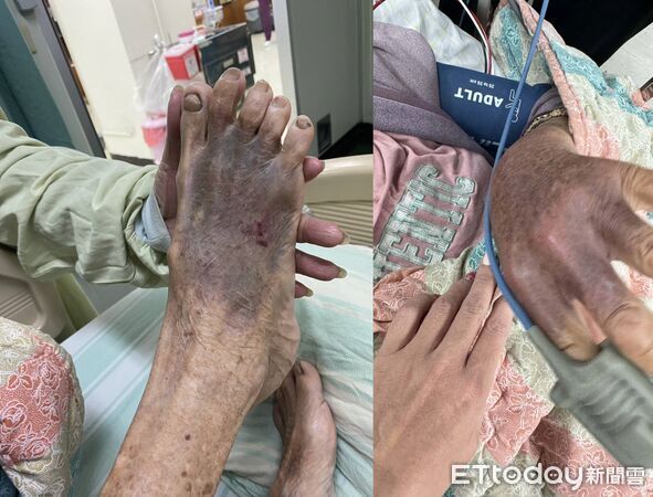 ▲屏東惡孫為錢痛毆90歲阿嬤，造成阿嬤全身多處瘀傷、腦出血。（圖／記者陳崑福翻攝）