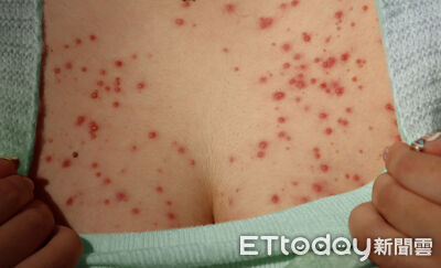 妹子拿舊藥膏擦痘痘！白嫩美胸「冒百顆紅痘」畫面曝　崩潰求醫