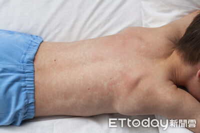 日本麻疹疫情升溫「初期像感冒傳染力強」　醫點名3類人補打疫苗