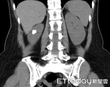 罕見腎結石害反覆泌尿道感染　醫曝拖延後果：腎化膿＋敗血症