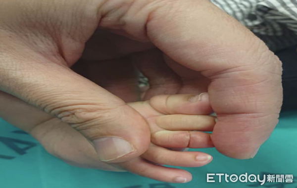 ▲▼    止血帶症候群         。（圖／許丁元醫師提供）